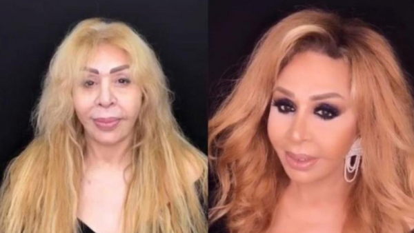 Əməkdar artist estetik əməliyyatın qurbanı oldu: "Çox peşmanam..."