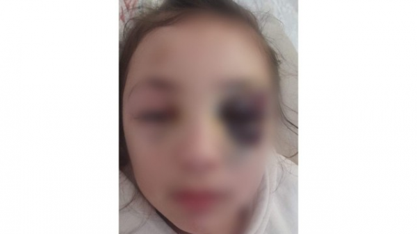 Bakıda şagirdin xəsarət alması ilə bağlı DİN-dən AÇIQLAMA