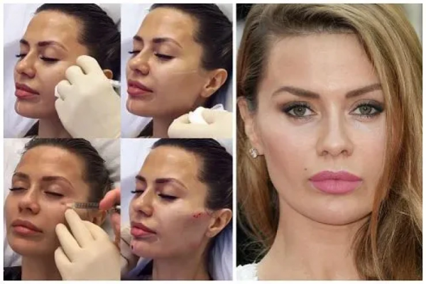 Dəfələrlə plastik əməliyyat etdirən məşhur model tanınmaz halda