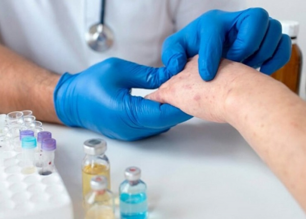 Rumıniyada qızılca epidemiyası elan edildi