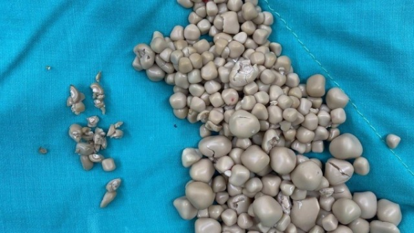 20 yaşlı qızın böyrəklərindən 300-dən çox daş çıxarıldı - FOTO
